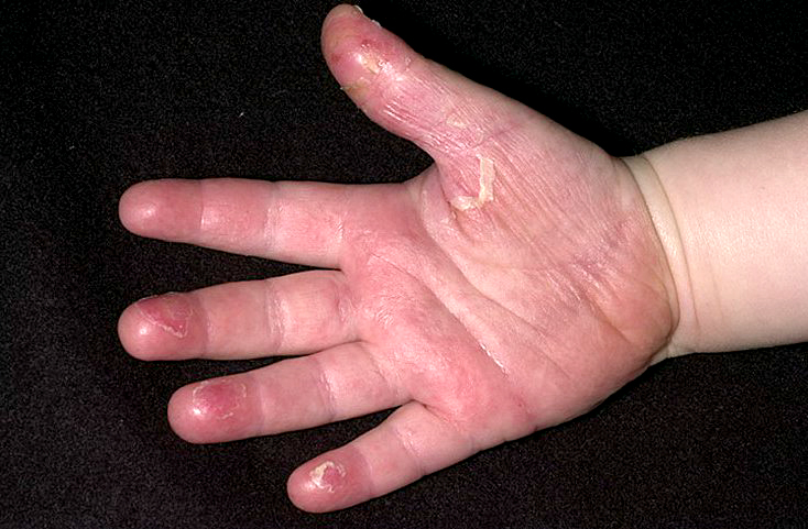 As rashes go, very few effect hands like Kawasaki Syndrome