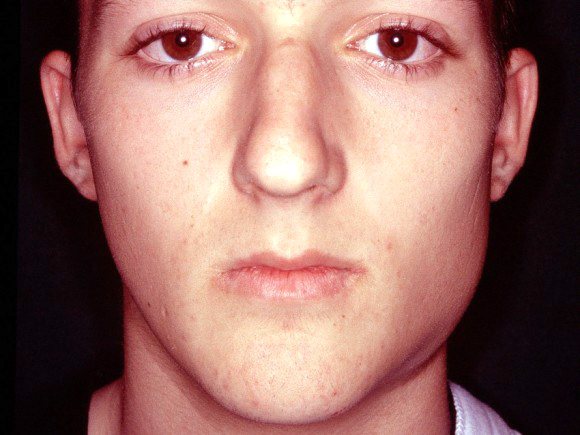 child diseases: Teenage boy with mumps