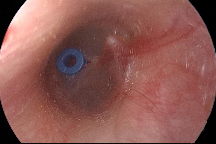 Ear Drum with PE tube (grommet) to treat "glue ear"