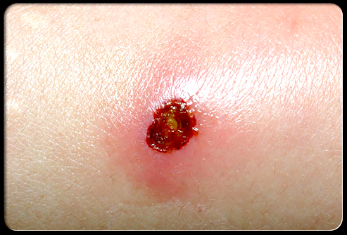 Skin ulcer and cellulitis caused by Staph Aureus