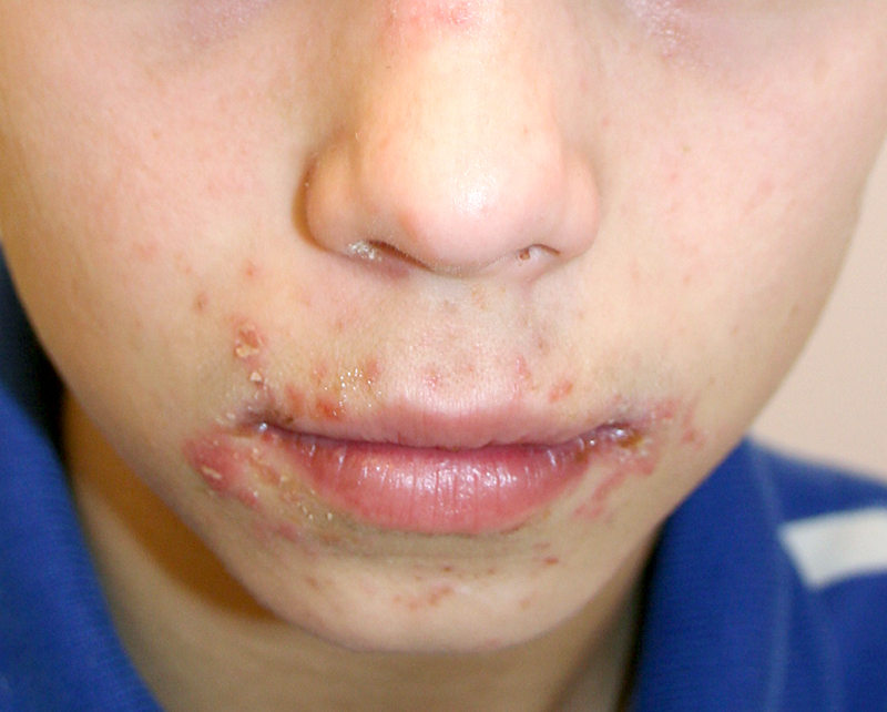 child diseases: Boy with nonbullous Impetigo on face