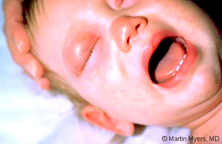 Baby with meningitis caused by Hemophylis Influenzae