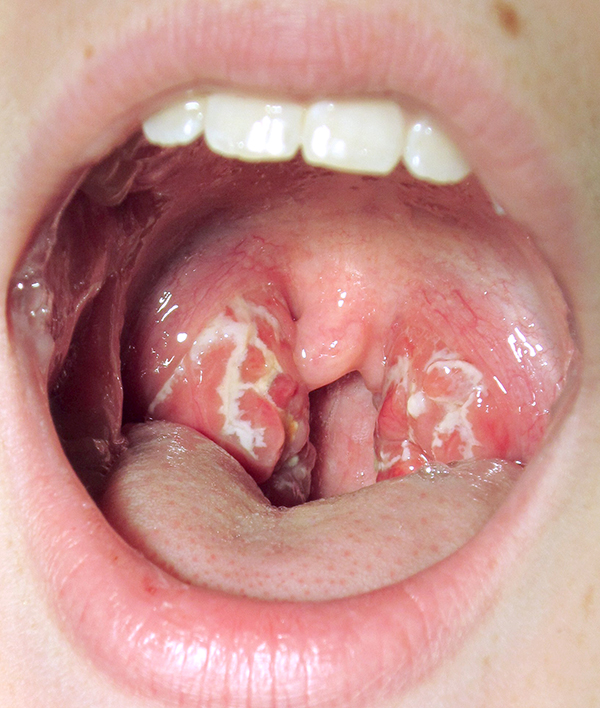 Sore throat (pharangitis) caused by "Strep"