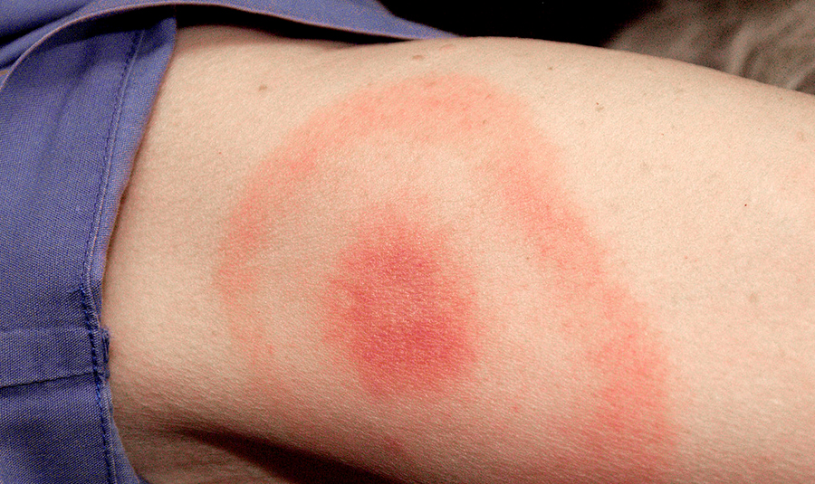 The "target" rash associated with Lyme disease