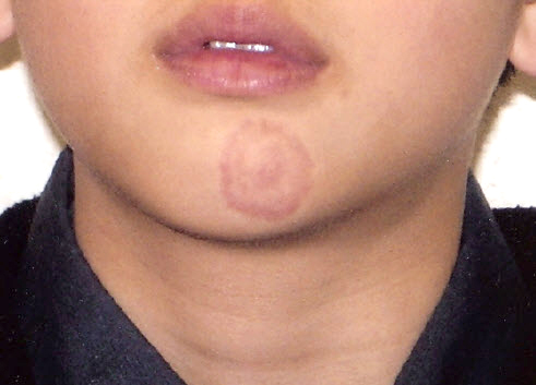 child diseases: Boy with ringworm - Tinea Corporis