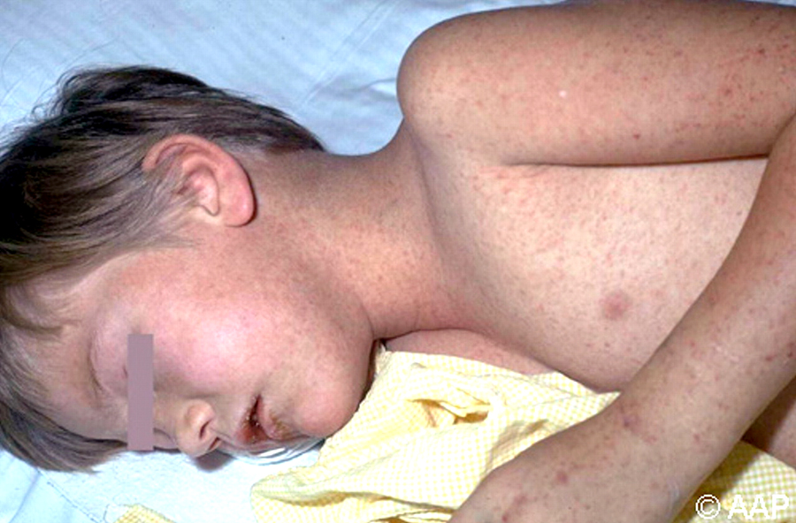 Boy with rash of Rocky Mountain Spotted Fever