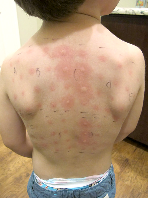 6 year old boy with marks of allergy skin tests