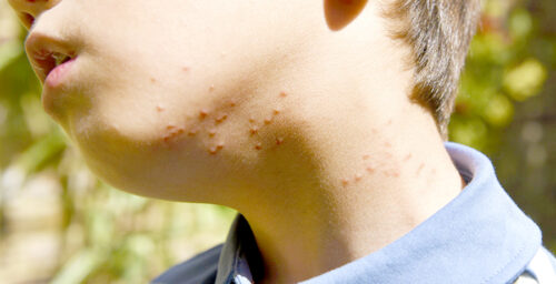 multiple mosquito bites on boys neck