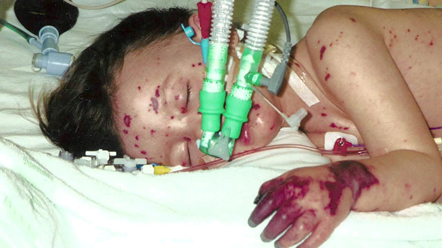 Child in ICU with meningococcal meningitis and purpura