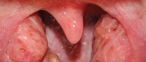 Normal childhood tonsils, "cryptic"