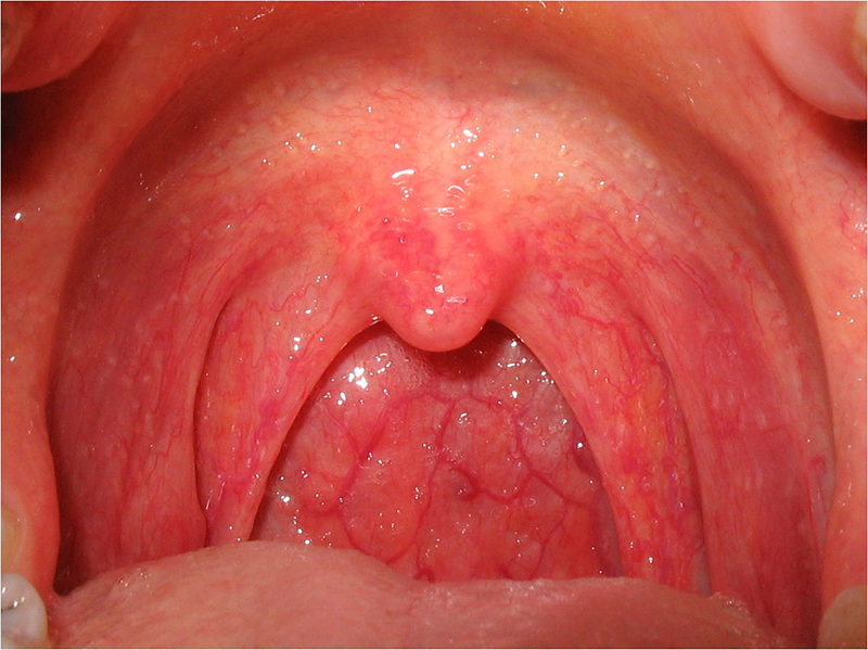 Normal teen throat, tonsils have gone away