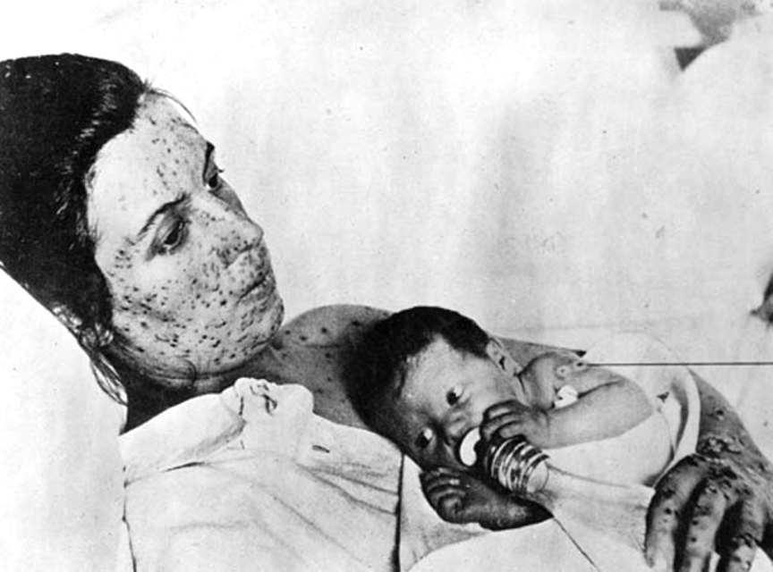 Mother and infant during smallpox epidemic