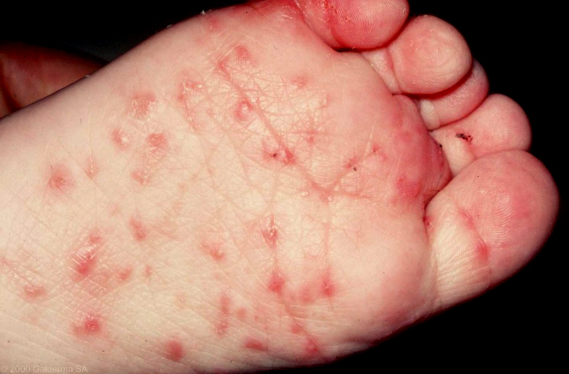 Scabies in a child