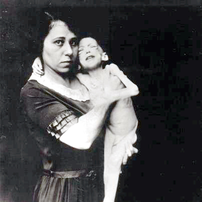 Mother holding her child who has Juvenile Onset Diabetes Mellitus