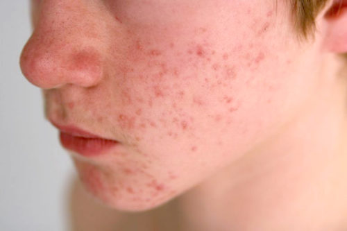 Teen boy with Acne vulgaris on face