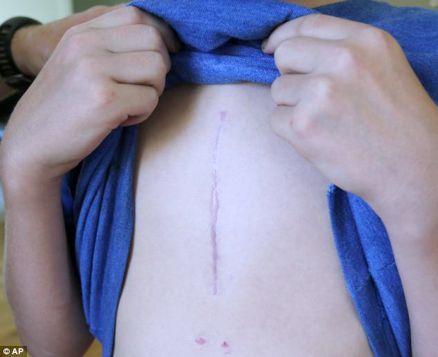 Boy showing scar from nail in heart by lawn mower