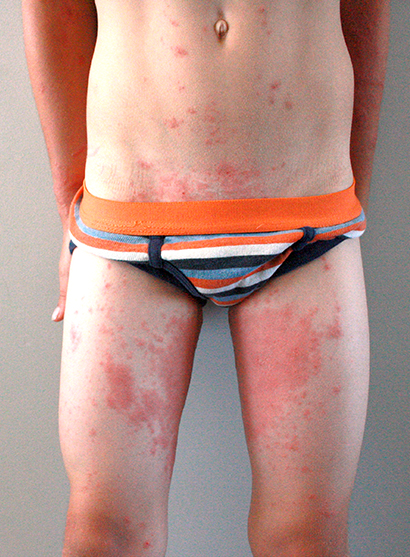 Boy with Poison Ivy rash in usual places